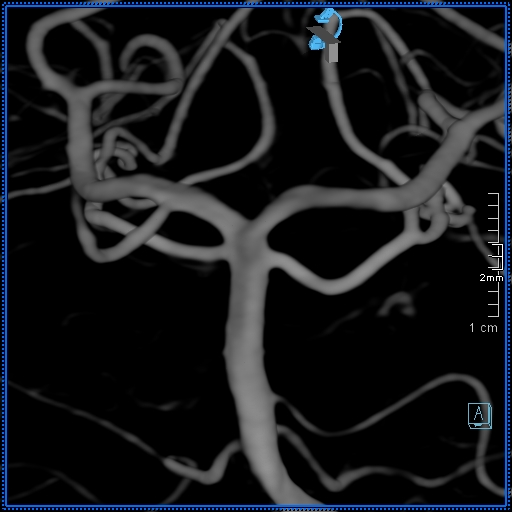 Basilar artery perforator aneurysm (Radiopaedia 82455-99524 3D Left VA 41).jpg