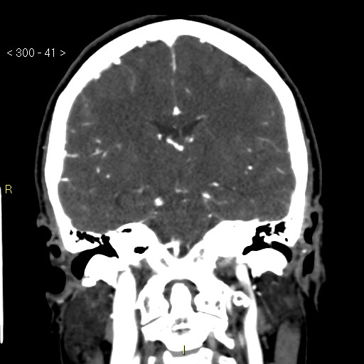 File:Basilar artery thrombosis (Radiopaedia 16260-15944 B 32).jpg