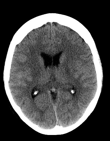 File:Basilar tip aneurysm with coiling (Radiopaedia 53912-60033 Axial non-contrast 15).jpg