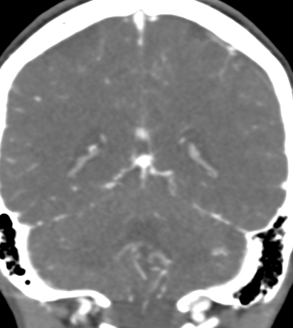 Basilar tip aneurysm with coiling (Radiopaedia 53912-60086 B 108).jpg