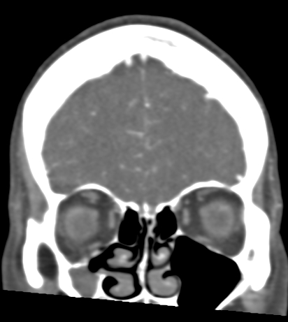 Basilar tip aneurysm with coiling (Radiopaedia 53912-60086 B 24).jpg
