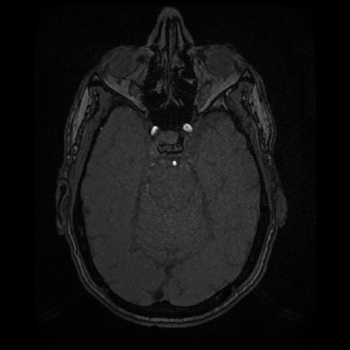 Basilar top and left middle cerebral artery aneurysm (Radiopaedia 61965-70031 Axial MRA 51).jpg