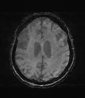 Behavioral variant frontotemporal dementia and late onset schizophrenia (Radiopaedia 52197-58083 Axial SWI 51).png