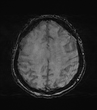 File:Behavioral variant frontotemporal dementia and late onset schizophrenia (Radiopaedia 52197-58083 Axial SWI 54).png
