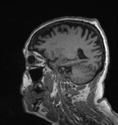 Behavioral variant frontotemporal dementia and late onset schizophrenia (Radiopaedia 52197-58083 Sagittal T1 72).png