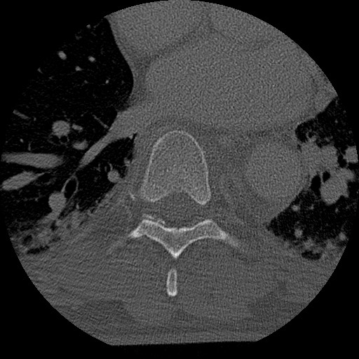 Benign post-traumatic pseudopneumoperitoneum (Radiopaedia 71199-81495 Axial bone window 109).jpg