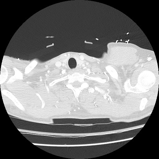 Benign post-traumatic pseudopneumoperitoneum (Radiopaedia 71199-81495 Axial lung window 11).jpg
