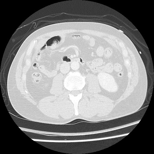 Benign post-traumatic pseudopneumoperitoneum (Radiopaedia 71199-81495 Axial lung window 90).jpg