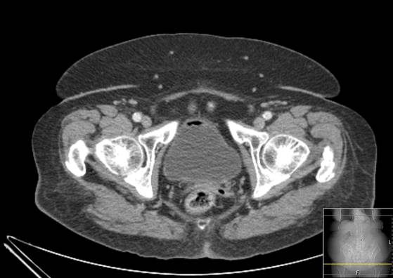 Bicameral celiacomesenteric aneurysm (Radiopaedia 55766-62327 A 70).jpg
