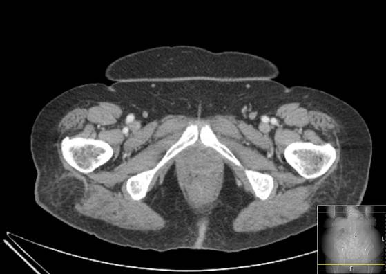 Bicameral celiacomesenteric aneurysm (Radiopaedia 55766-62327 A 77).jpg