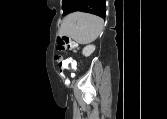 Bicameral celiacomesenteric aneurysm (Radiopaedia 55766-62327 B 15).jpg