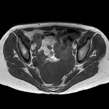 File:Bicornuate uterus (Radiopaedia 61974-70046 Axial T1 27).jpg