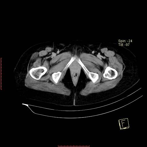 File:Bifid ureter (Radiopaedia 47604-52253 Axial C+ delayed 33).jpg