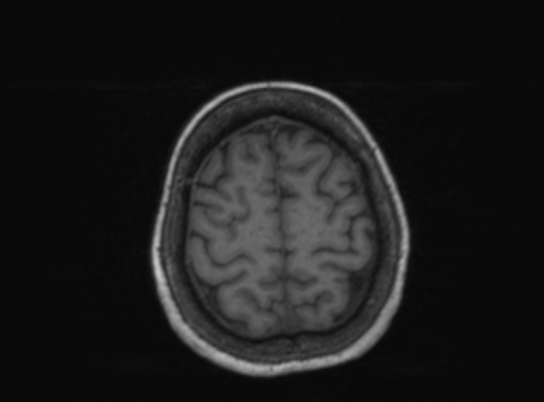 File:Bilateral PCA territory infarction - different ages (Radiopaedia 46200-51784 Axial T1 151).jpg