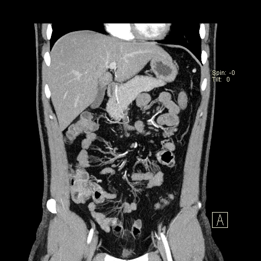 File:Bilateral accessory renal arteries with mild pelvi-ureteric junction (PUJ) obstruction (Radiopaedia 66357-75596 B 1).jpg