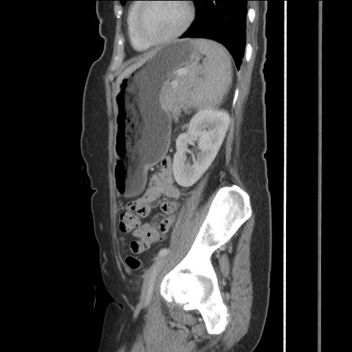 Bilateral adrenal granulocytic sarcomas (chloromas) (Radiopaedia 78375-91007 C 98).jpg