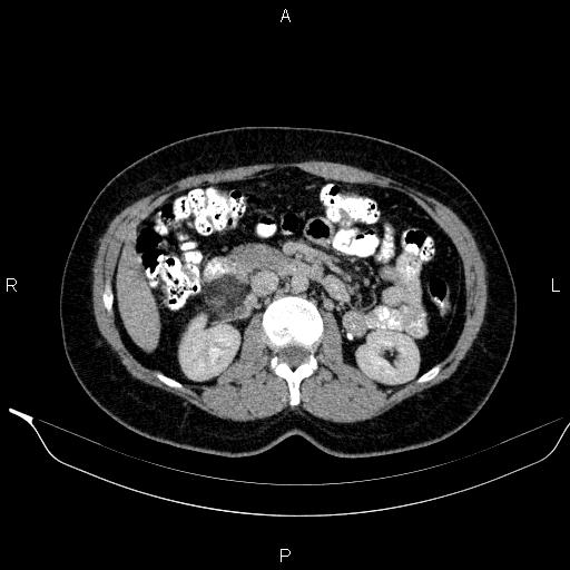 File:Bilateral adrenal myelolipoma (Radiopaedia 63058-71535 Axial C+ delayed 53).jpg