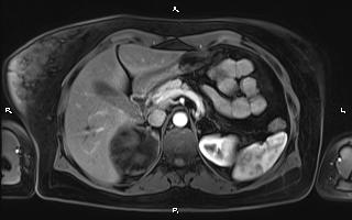 Bilateral adrenal myelolipoma (Radiopaedia 63058-71537 Axial T1 C+ fat sat 34).jpg