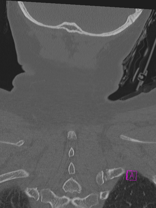 Bilateral atlanto-occipital assimilation (Radiopaedia 28350-28603 Coronal bone window 48).jpg