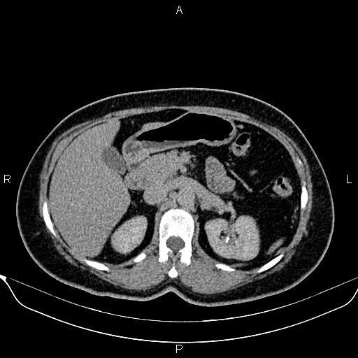 Bilateral benign adrenal adenomas (Radiopaedia 86912-103124 Axial C+ delayed 42).jpg