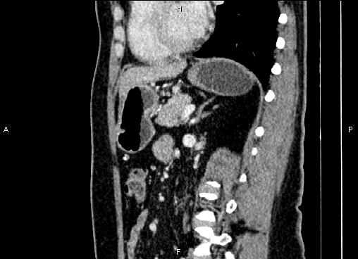 Bilateral benign adrenal adenomas (Radiopaedia 86912-103124 E 60).jpg