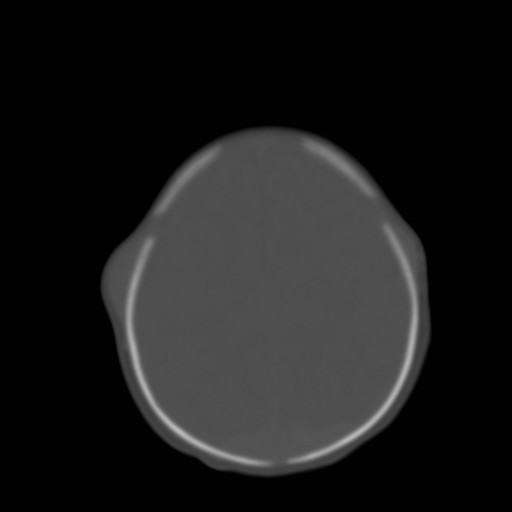 File:Bilateral cephalohematomas and subdural hematomas (Radiopaedia 26778-26929 Axial bone window 23).jpg