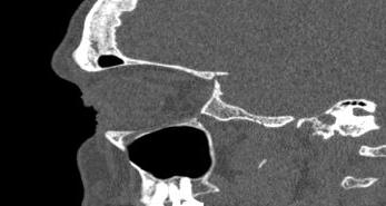 File:Bilateral ectopic infraorbital nerves (Radiopaedia 49006-54084 Sagittal 34).png