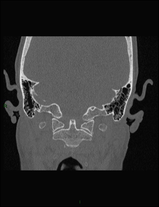 Bilateral frontal mucoceles (Radiopaedia 82352-96454 Coronal 348).jpg