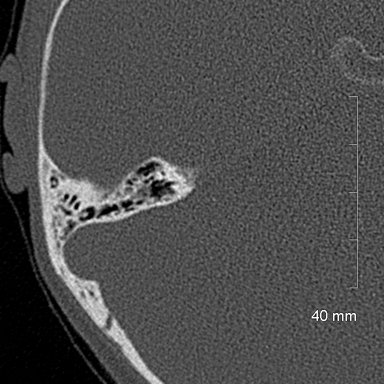Bilateral grommets (Radiopaedia 47710-52404 Axial bone window 60).jpg