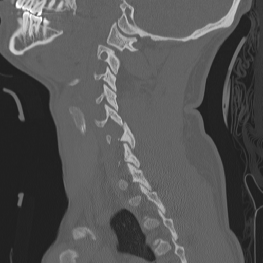 Bilateral locked facets (Radiopaedia 33850-35016 Sagittal bone window 35).png