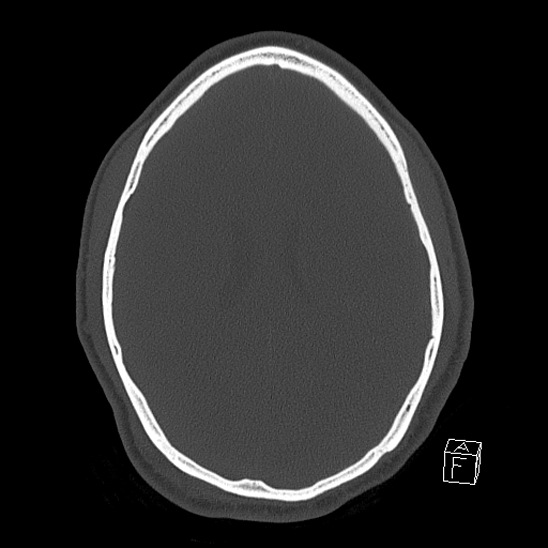 File:Bilateral occipital condyle fracture (type 2) (Radiopaedia 87675-104089 Axial bone window 87).jpg