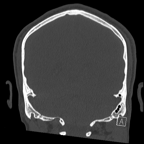 Bilateral occipital condyle fracture (type 2) (Radiopaedia 87675-104089 Coronal bone window 99).jpg