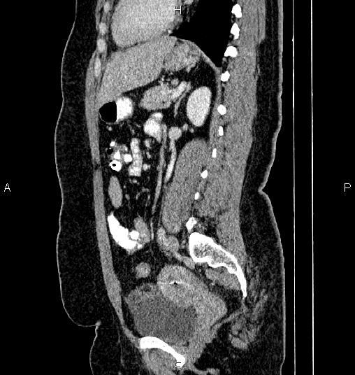 Bilateral ovarian dermoid cysts (Radiopaedia 85785-101603 D 57).jpg