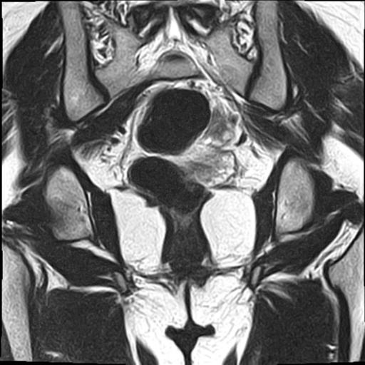 File:Bilateral ovarian endometriomas (Radiopaedia 87085-103347 Coronal T2 15).jpg