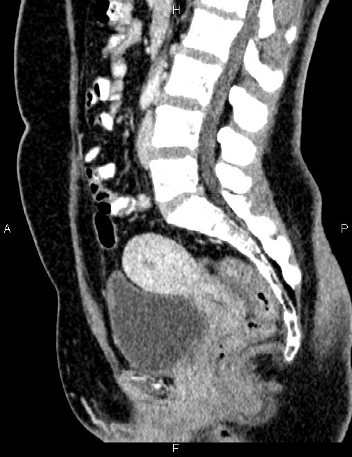 Bilateral ovarian teratoma (Radiopaedia 83131-97503 D 62).jpg