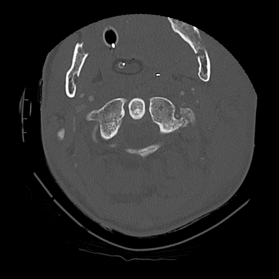 File:Bilateral perched facets with cord injury (Radiopaedia 45587-49713 Axial bone window 28).jpg