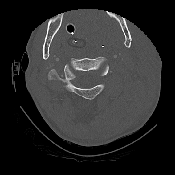File:Bilateral perched facets with cord injury (Radiopaedia 45587-49713 Axial bone window 32).jpg