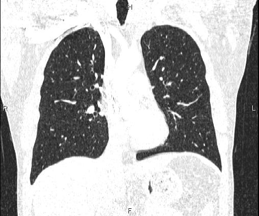Bilateral pulmonary AVM (Radiopaedia 83134-97505 Coronal lung window 39).jpg