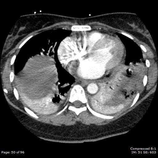 File:Bilateral pulmonary emboli with Hampton hump sign (Radiopaedia 54070-60246 Axial C+ CTPA 47).jpg