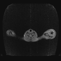 File:Bilateral spinoglenoid notch ganglion cysts (Radiopaedia 29577-30082 E 2).jpg