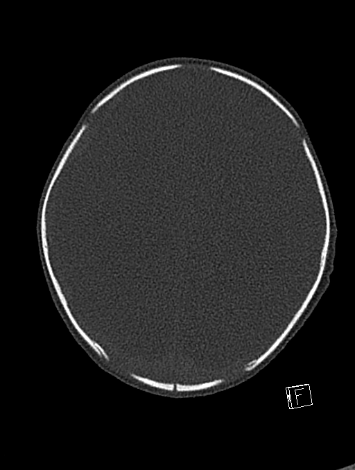 Bilateral subdural hemorrhage and parietal skull fracture (Radiopaedia 26058-26192 Axial bone window 41).png