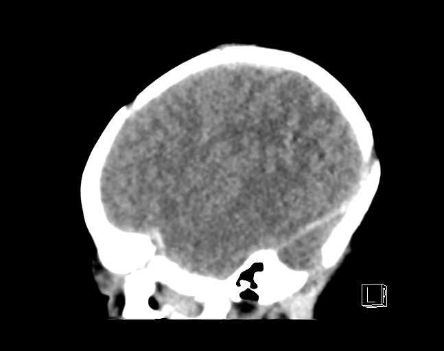 File:Bilateral subdural hemorrhage and parietal skull fracture (Radiopaedia 26058-26192 C 19).png