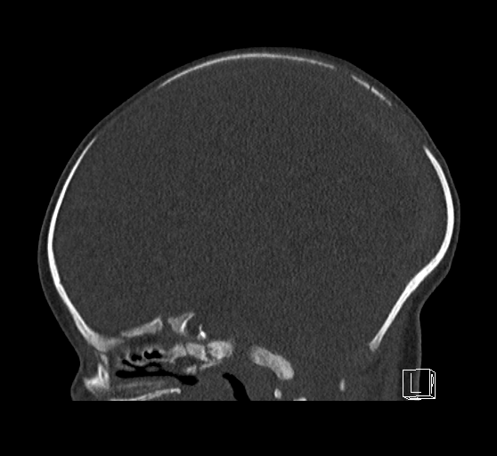 Bilateral subdural hemorrhage and parietal skull fracture (Radiopaedia 26058-26192 Sagittal bone window 43).png