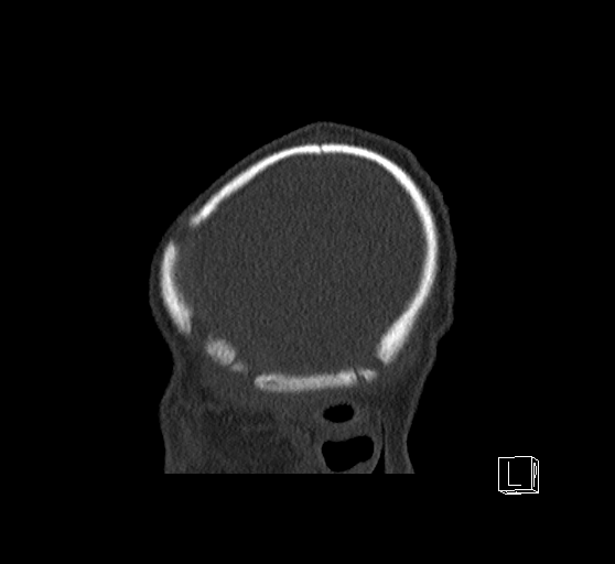 Bilateral subdural hemorrhage and parietal skull fracture (Radiopaedia 26058-26192 Sagittal bone window 88).png