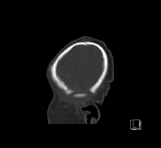 Bilateral subdural hemorrhage and parietal skull fracture (Radiopaedia 26058-26192 Sagittal bone window 91).png