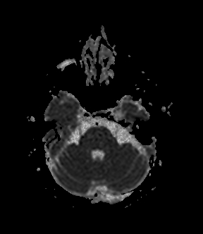 File:Bilateral thalamic glioma (Radiopaedia 65852-75009 Axial ADC 6).jpg