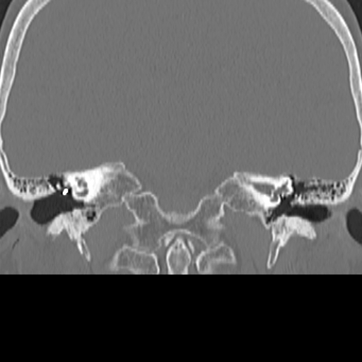 File:Bilateral tympanoplasty (Radiopaedia 16947-16664 Coronal bone window 12).jpg