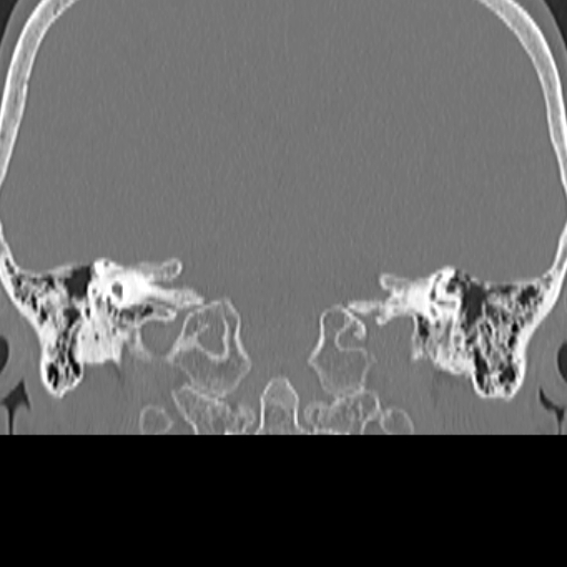 File:Bilateral tympanoplasty (Radiopaedia 16947-16664 Coronal bone window 17).jpg