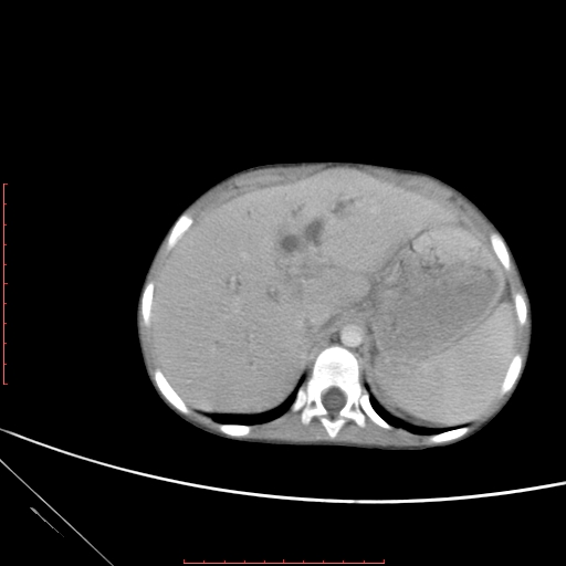 Biliary tract embryonal rhabdomyosarcoma (Radiopaedia 51815-57648 A 16).jpg