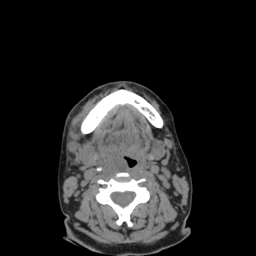 File:Bisphosphonate-related osteonecrosis of the jaw (Radiopaedia 71324-81642 non-contrast 34).jpg